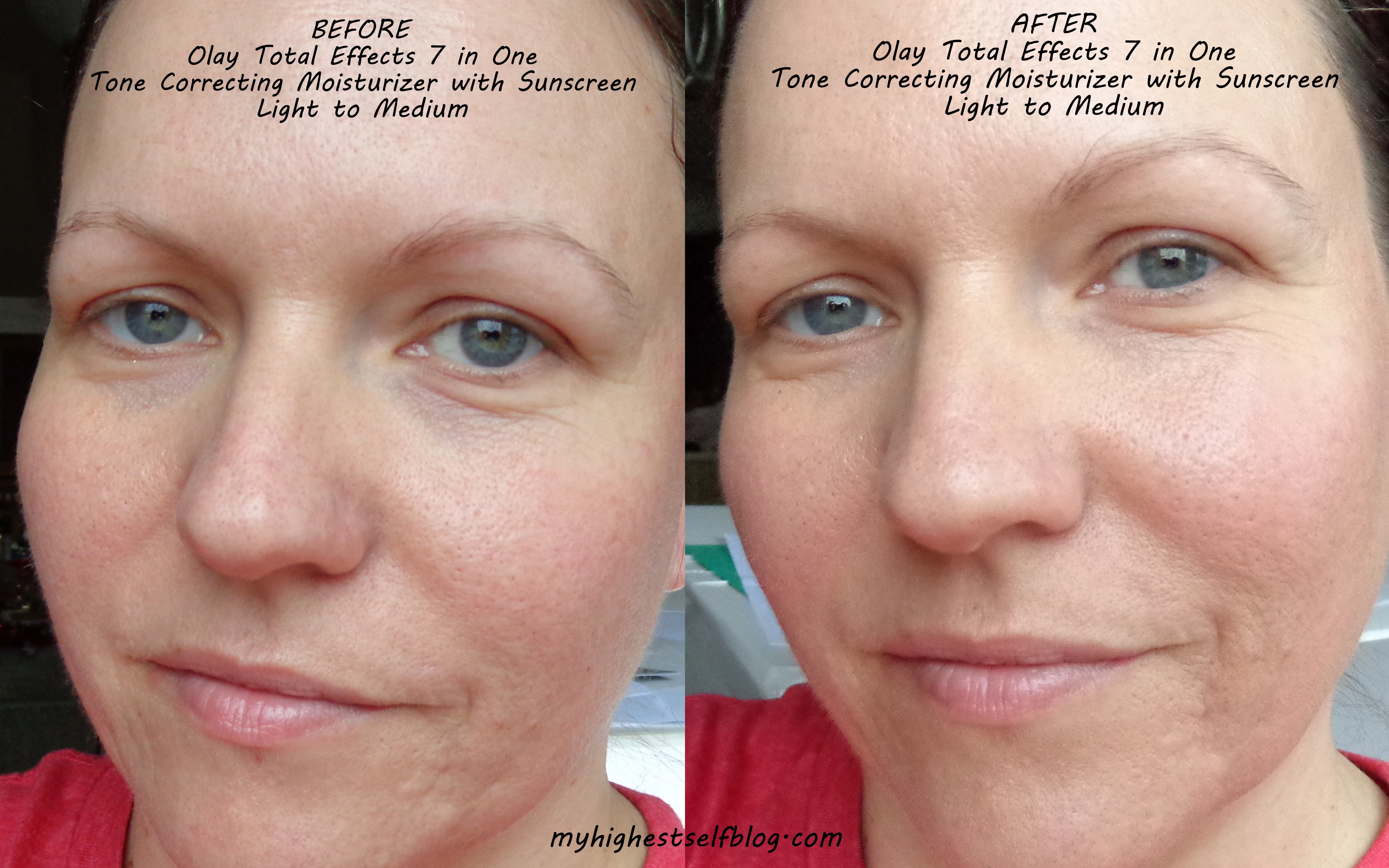 Pimple Cream Before Or After Moisturizer At John Bobo Blog