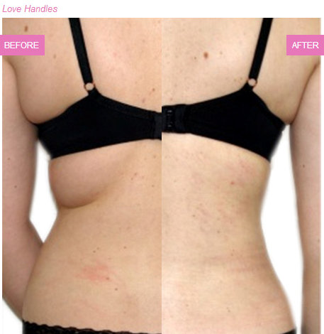 Liposuction Austin