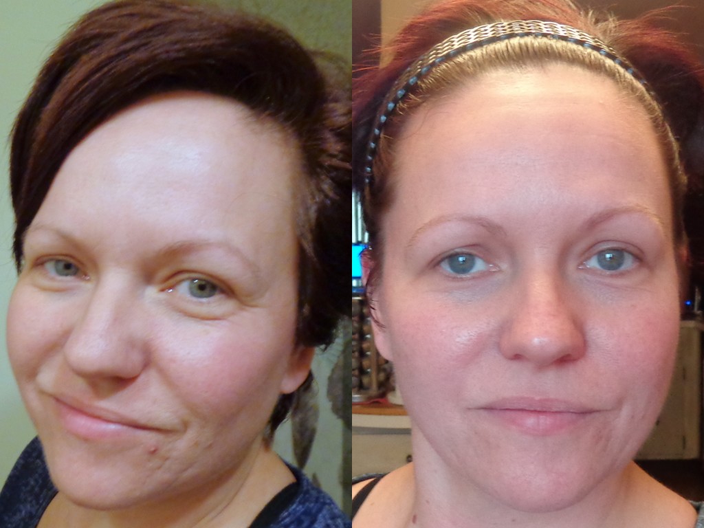 Proactiv Plus Before and After